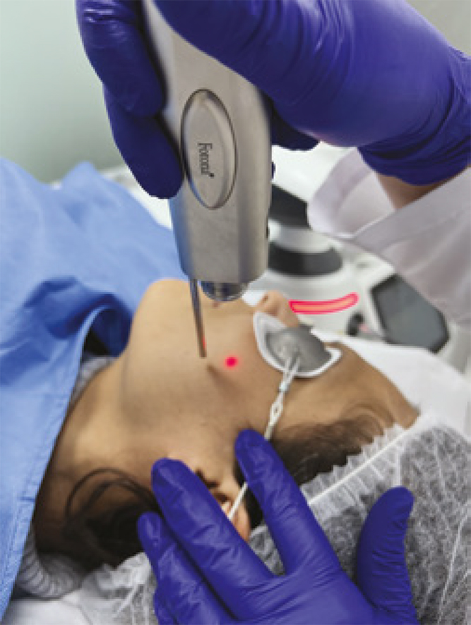Tratamiento de rejuvenecimiento facial con láser Fotona